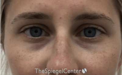 Tear Trough / Under Eye Fillers Before & After Gallery - Patient 202211 - Image 1