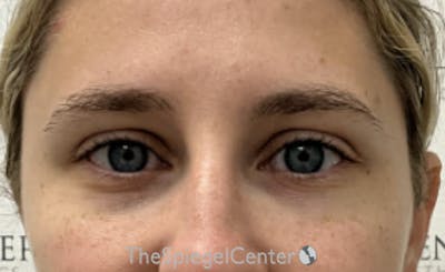 Temple Filler Before & After Gallery - Patient 157140557 - Image 2