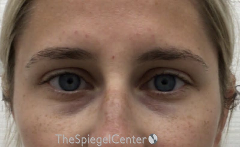 Temple Filler Before & After Gallery - Patient 157140557 - Image 1