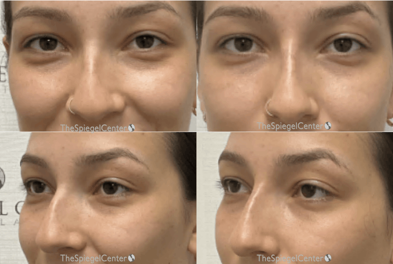 Non-Surgical Rhinoplasty / Nose Filler Before & After Gallery - Patient 193345 - Image 1