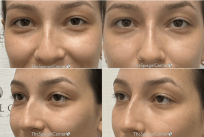 Non-Surgical Rhinoplasty / Nose Filler Before & After Gallery - Patient 193345 - Image 1