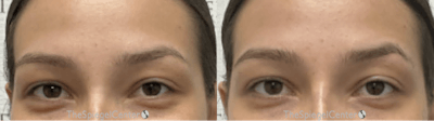Temple Filler Before & After Gallery - Patient 148034 - Image 1