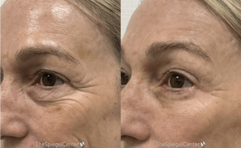 IPL / Intense Pulse Light Before & After Gallery - Patient 691877 - Image 1