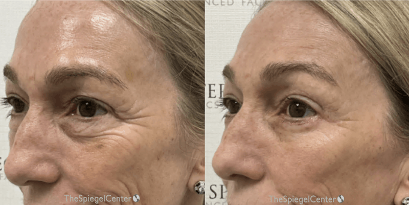 Morpheus8 Before & After Gallery - Patient 200917 - Image 1