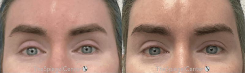 Temple Filler Before & After Gallery - Patient 166703 - Image 1