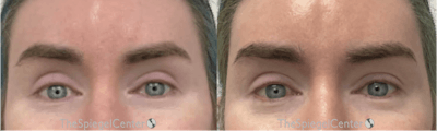 Temple Filler Before & After Gallery - Patient 166703 - Image 1