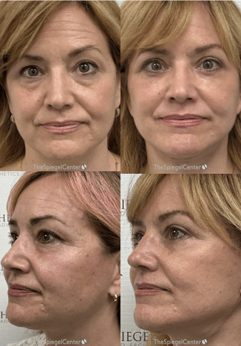 Facelift Before & After Gallery - Patient 797944 - Image 1