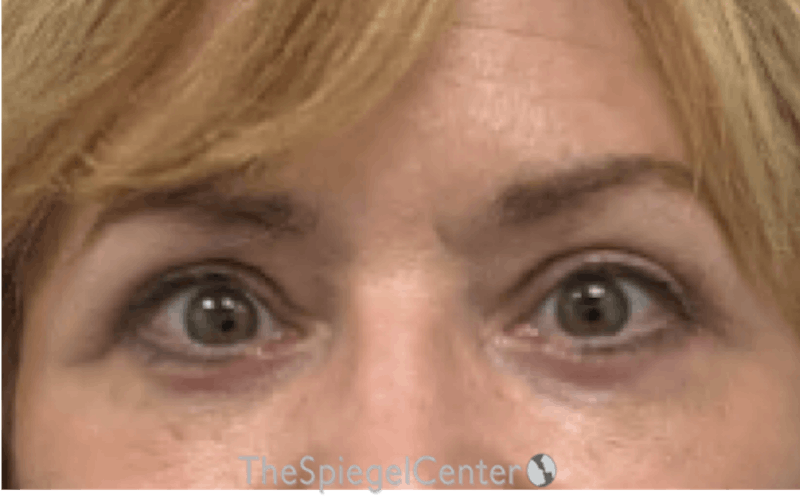 Blepharoplasty Before & After Gallery - Patient 189823 - Image 2