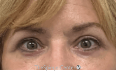 Blepharoplasty Before & After Gallery - Patient 189823 - Image 2