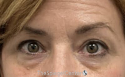 Blepharoplasty Before & After Gallery - Patient 189823 - Image 1