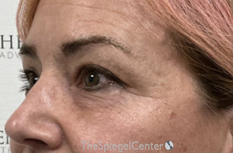 Blepharoplasty Before & After Gallery - Patient 189823 - Image 3