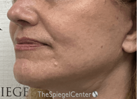 Ellacor Before & After Gallery - Patient 349790 - Image 4