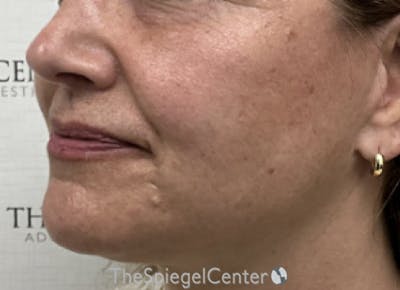 Ellacor Before & After Gallery - Patient 349790 - Image 3