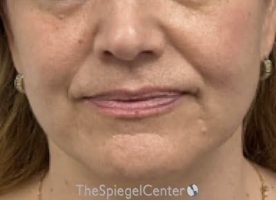 Ellacor Before & After Gallery - Patient 349790 - Image 1