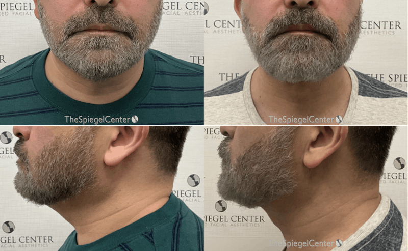 Facetite / Necktite / Embrace / Accutite Before & After Gallery - Patient 296288 - Image 1