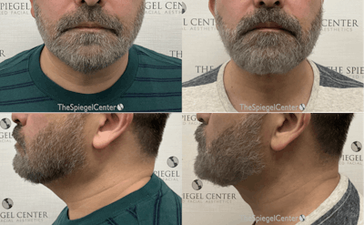 Facetite / Necktite / Embrace / Accutite Before & After Gallery - Patient 296288 - Image 1