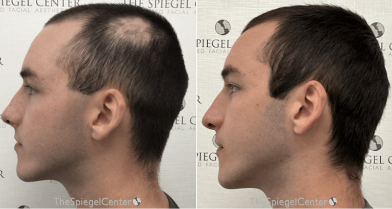 PRP Before & After Gallery - Patient 278112 - Image 1