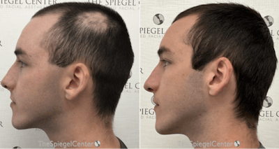 Hair Restoration Before & After Gallery - Patient 283498 - Image 1