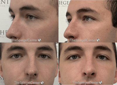 Rhinoplasty Before & After Gallery - Patient 306350 - Image 1