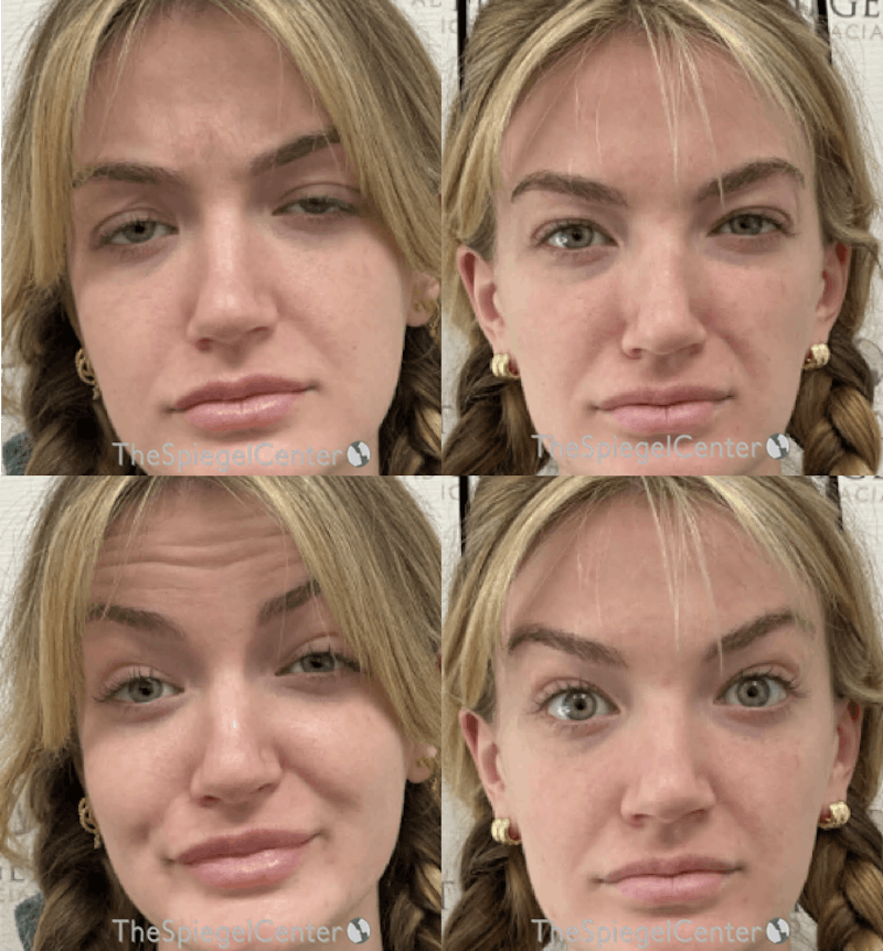 Botox / Dysport / Jeuveau / Xeomin Before & After Gallery - Patient 300768 - Image 1