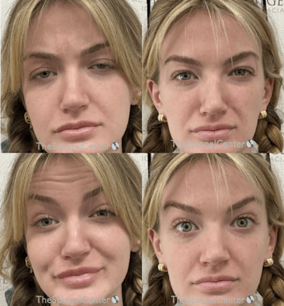 Botox / Dysport / Jeuveau / Xeomin Before & After Gallery - Patient 300768 - Image 1