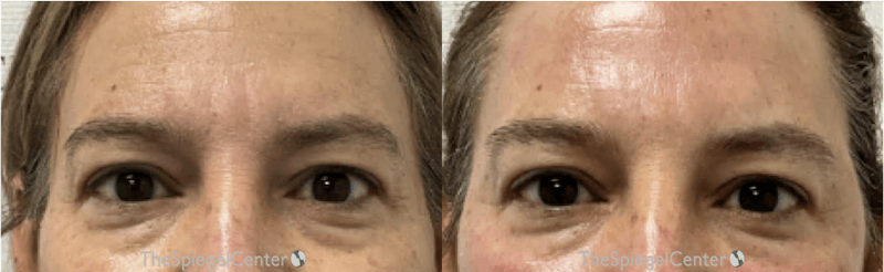 Temple Filler Before & After Gallery - Patient 192018 - Image 1