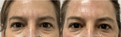 Temple Filler Before & After Gallery - Patient 192018 - Image 1