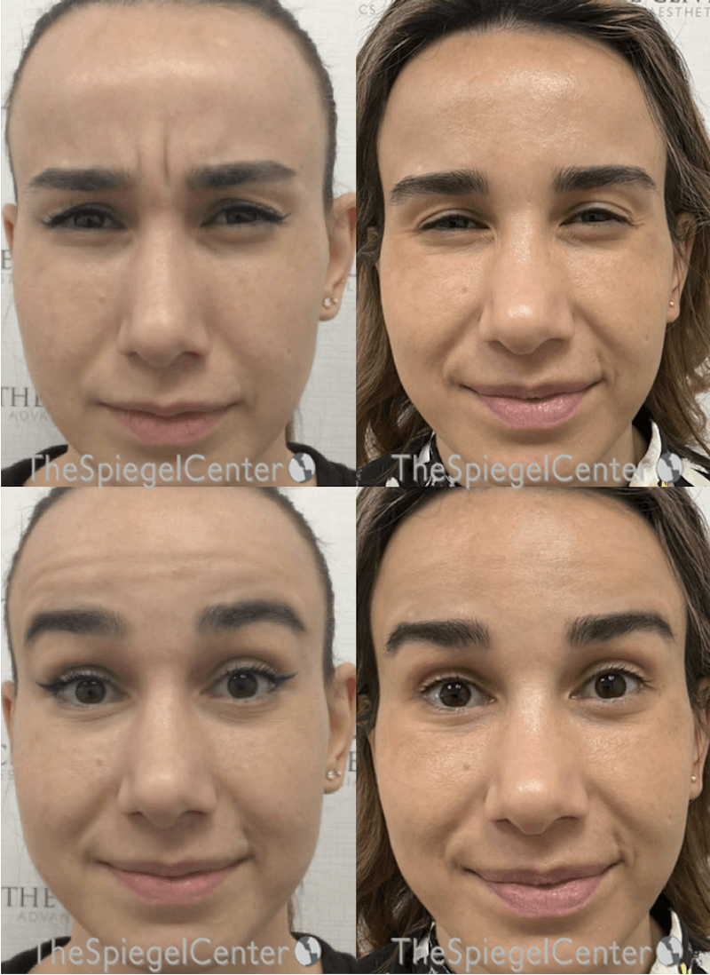 Botox / Dysport / Jeuveau / Xeomin Before & After Gallery - Patient 344902 - Image 1