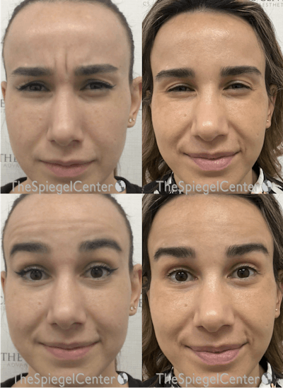 Botox / Dysport / Jeuveau / Xeomin Before & After Gallery - Patient 344902 - Image 1