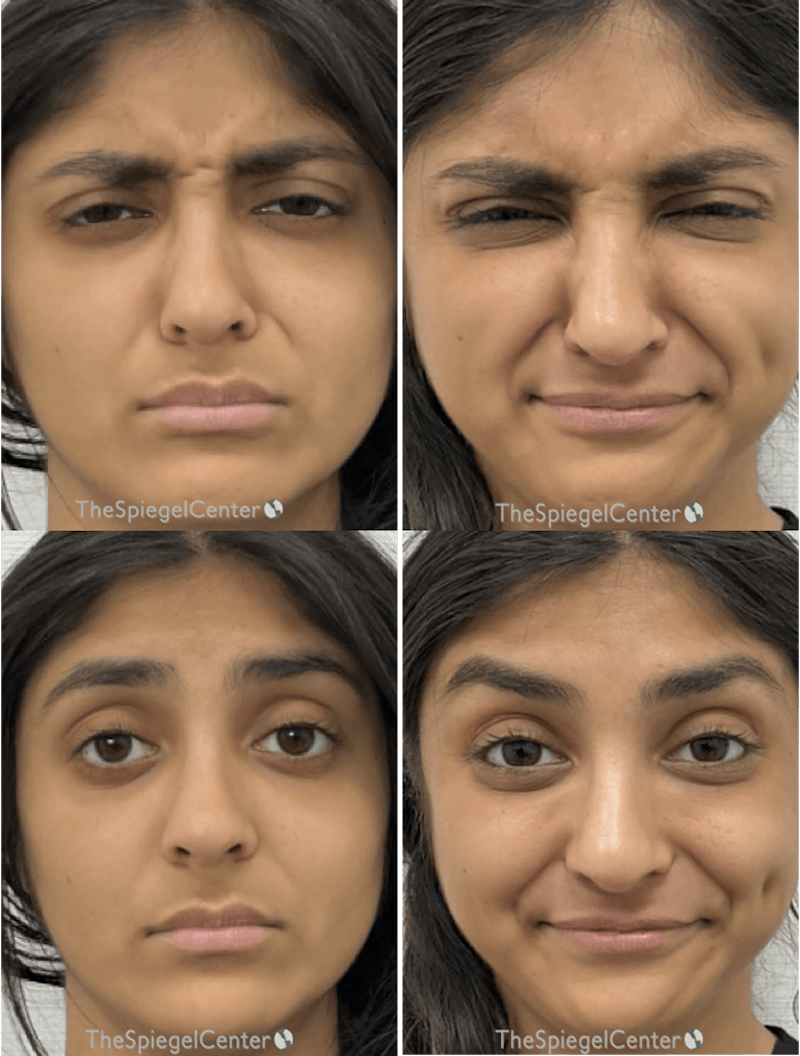 Botox / Dysport / Jeuveau / Xeomin Before & After Gallery - Patient 191552 - Image 1