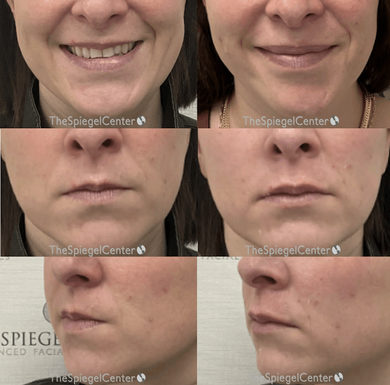 Lip Filler Before & After Gallery - Patient 113369 - Image 1