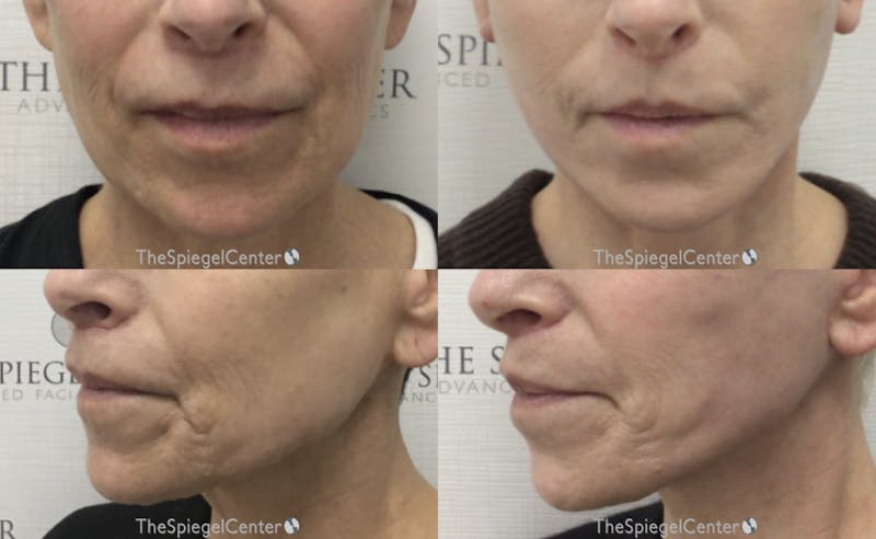 Nasolabial Fold Filler Before & After Gallery - Patient 309639 - Image 1