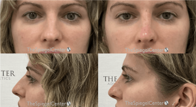 Non-Surgical Rhinoplasty / Nose Filler Before & After Gallery - Patient 341594 - Image 1
