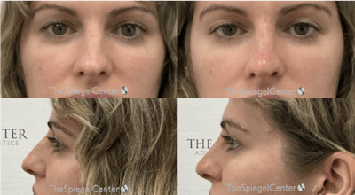 Non-Surgical Rhinoplasty / Nose Filler Before & After Gallery - Patient 341594 - Image 1