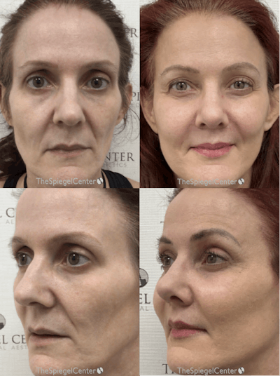 Facial Fat Grafting Before & After Gallery - Patient 383230 - Image 1