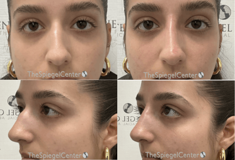 Non-Surgical Rhinoplasty / Nose Filler Before & After Gallery - Patient 160618 - Image 1