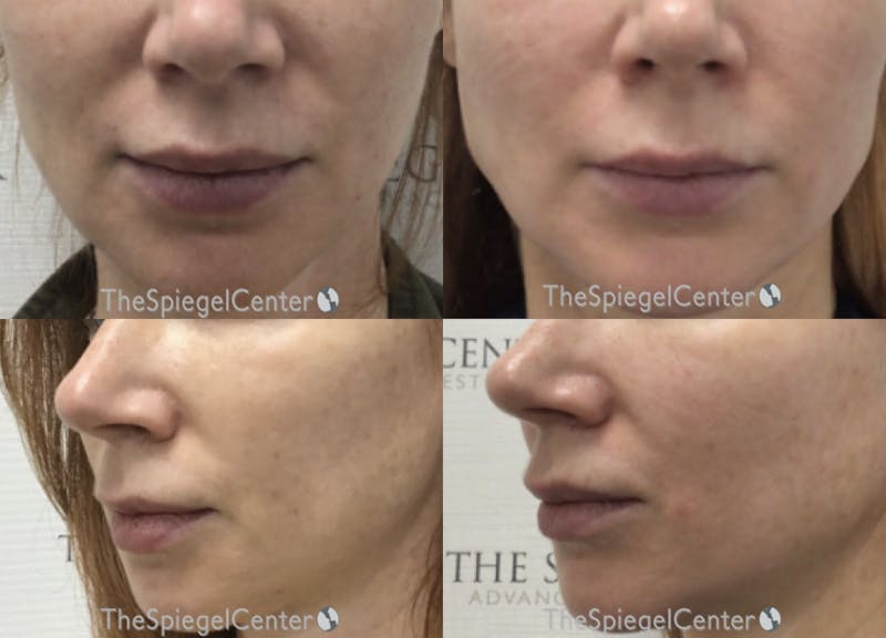 Nasolabial Fold Filler Before & After Gallery - Patient 385245 - Image 1