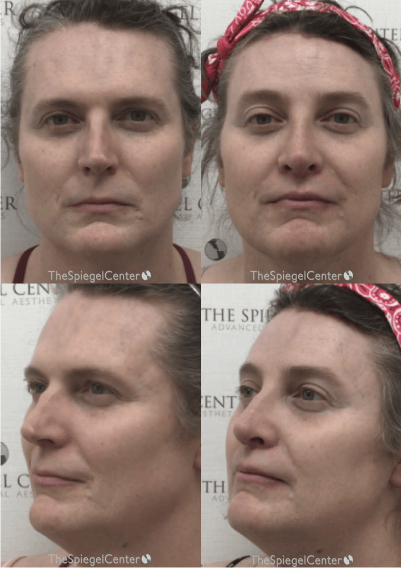 FFS Before & After Gallery - Patient 658649 - Image 1