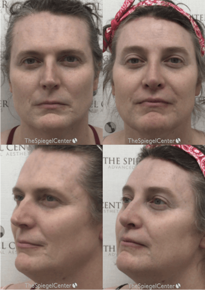 FFS Before & After Gallery - Patient 658649 - Image 1