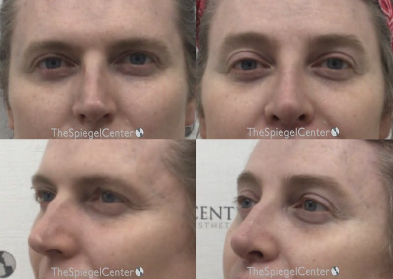 Rhinoplasty Before & After Gallery - Patient 556488 - Image 1