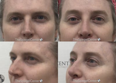 Rhinoplasty Before & After Gallery - Patient 556488 - Image 1