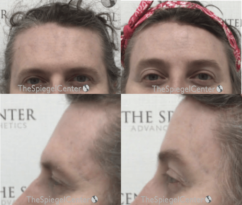 Scalp Advancement Before & After Gallery - Patient 405175 - Image 1