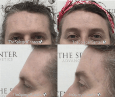 Forehead Contouring Before & After Gallery - Patient 110668 - Image 1