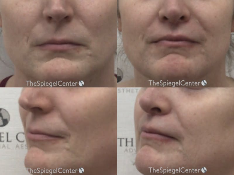 Lip Lift Before & After Gallery - Patient 341995 - Image 1