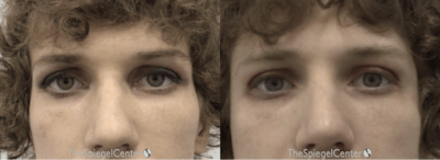 Temple Filler Before & After Gallery - Patient 247008 - Image 1