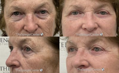 Blepharoplasty Before & After Gallery - Patient 266683 - Image 1