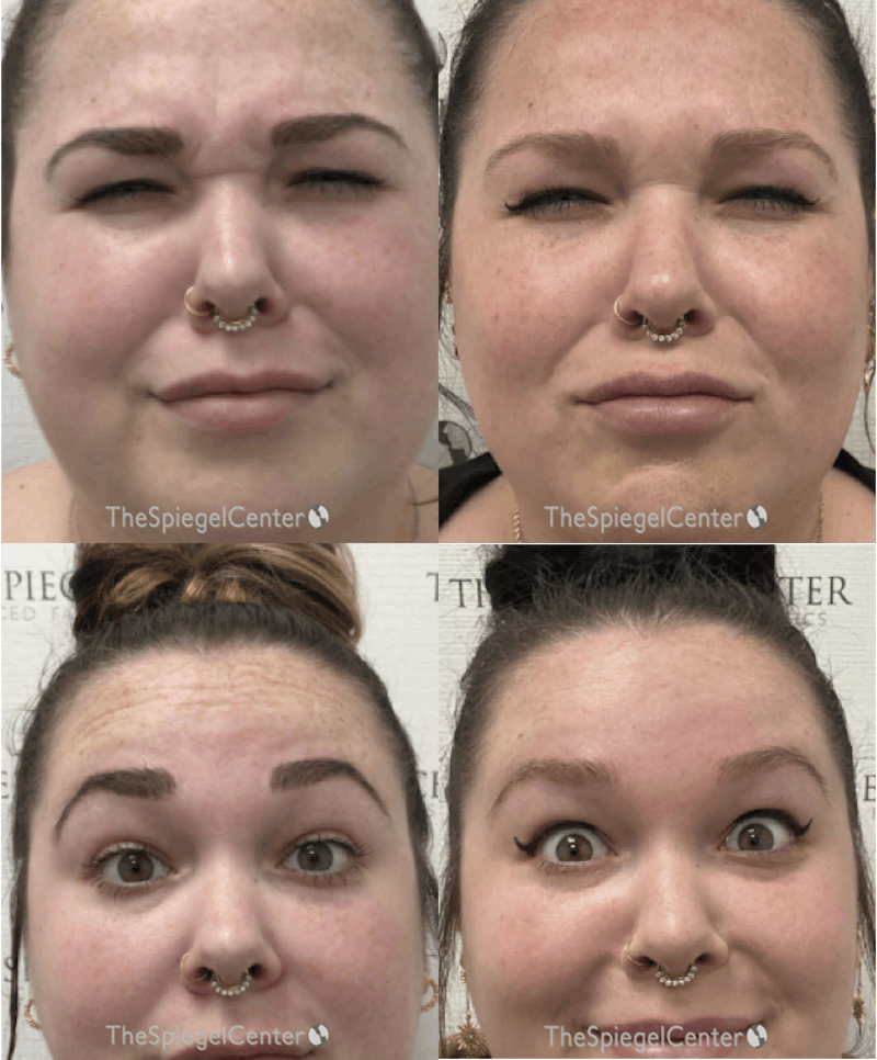Botox / Dysport / Jeuveau / Xeomin Before & After Gallery - Patient 325359 - Image 1