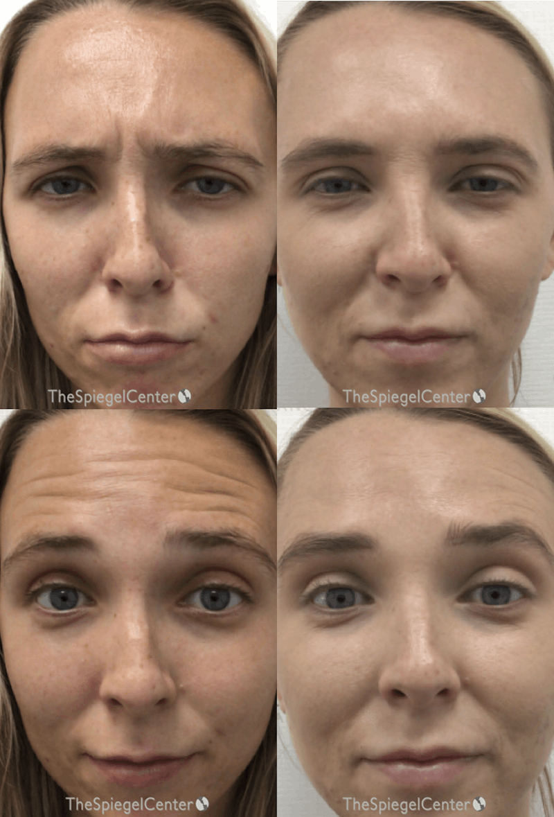 Botox / Dysport / Jeuveau / Xeomin Before & After Gallery - Patient 109817 - Image 1