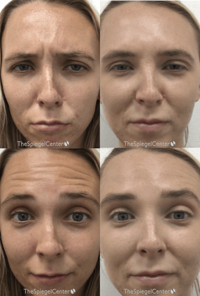 Botox / Dysport / Jeuveau / Xeomin Before & After Gallery - Patient 109817 - Image 1