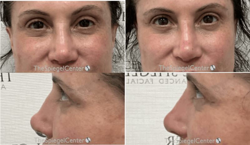 Non-Surgical Rhinoplasty / Nose Filler Before & After Gallery - Patient 707017 - Image 1